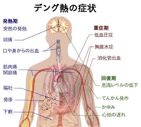 16.4.7.wikipediaデング熱の症状