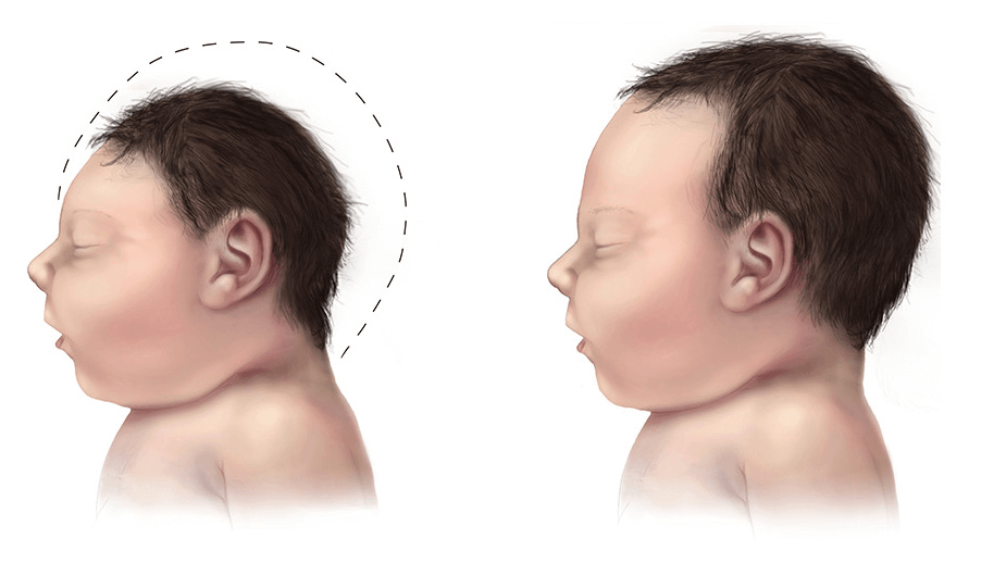 Microcephaly comparison 500px ジカウイルス Wikipedia